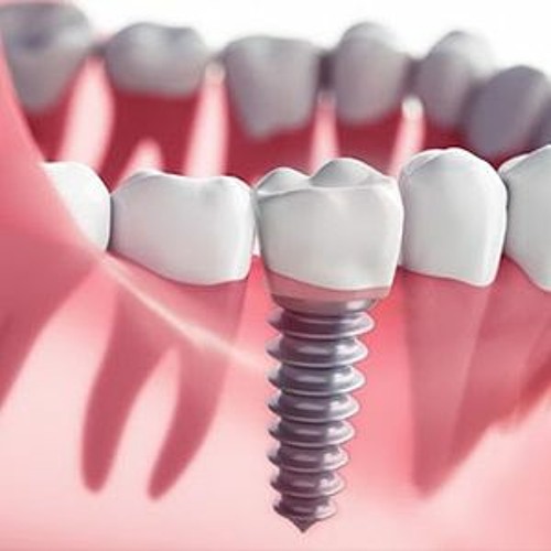 Лечение и имплантация зубов