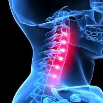 Шейно-плечевой радикулит: диагностика, методы лечения и профилактика заболевания